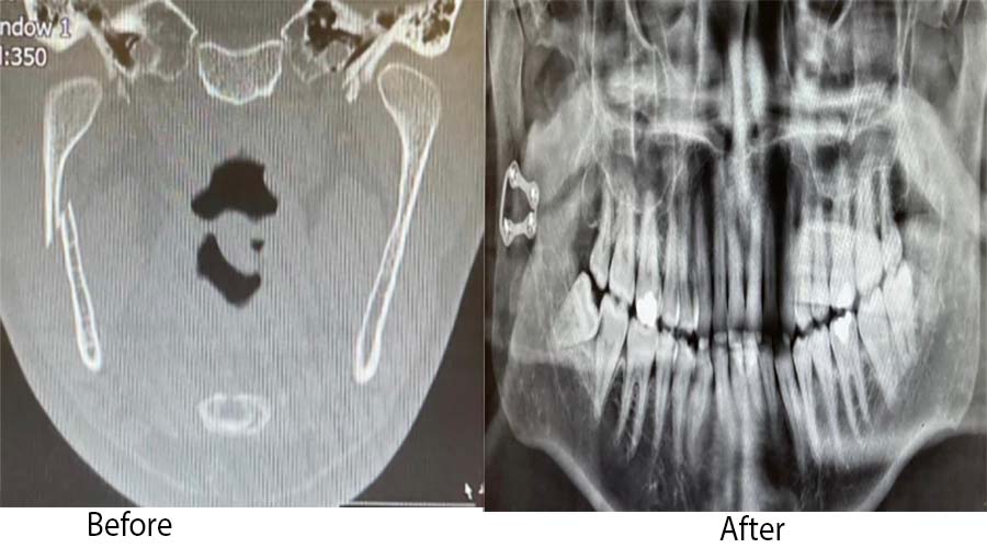Facial Surgery